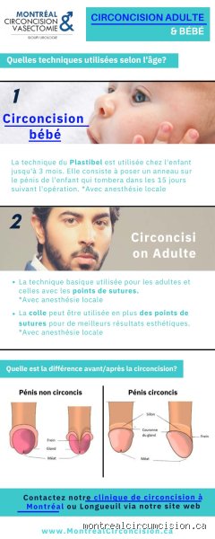 Quel est l'âge idéal pour la circoncision ?