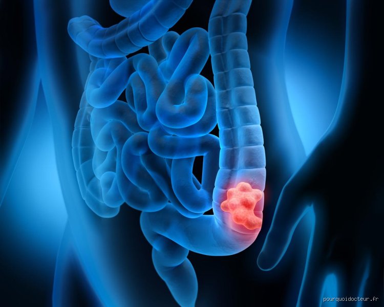 Quel est le cancer qui fait perdre du poids ? Comprendre l'amaigrissement inexpliqué et les mécanismes de la cachexie cancéreuse
