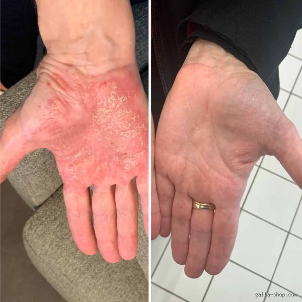 Quel est le pire mois pour l'eczéma ? Le verdict des dermatologues et la vérité sur les pics de crises saisonnières