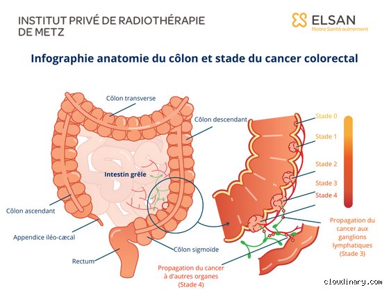 Quel est le premier stade du cancer du côlon ? Comprendre l'étape charnière du diagnostic précoce
