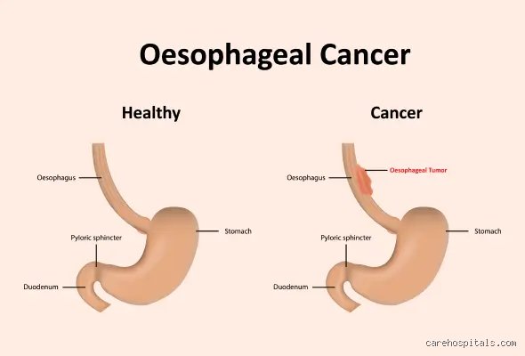 Quel est le processus de mort du cancer de l'œsophage ?