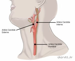 Quel examen pour voir les carotides ?