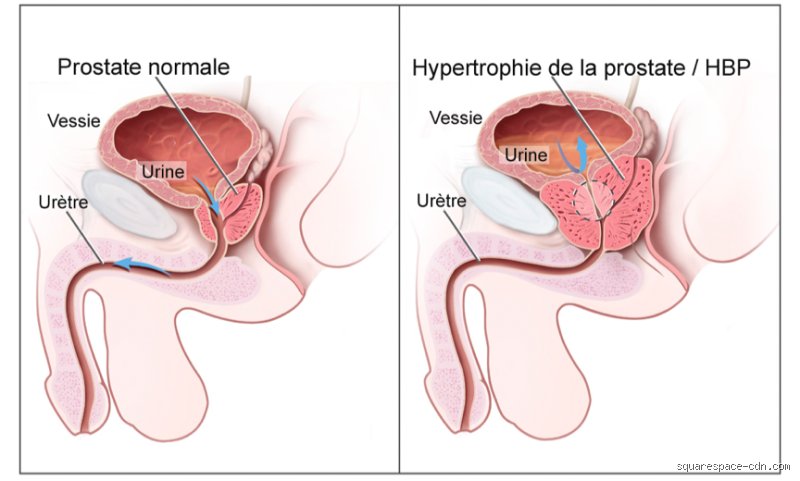 Quel inconvénient de ne plus avoir de prostate ? Tout ce qu'on ne vous dit pas avant l'opération