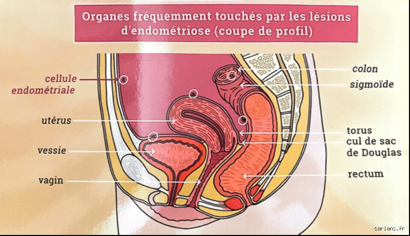 Quel organe peut toucher l'endométriose ? Cartographie exhaustive d'une pathologie qui dépasse largement le cadre de l'utérus