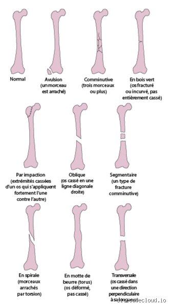 Quel os se casse facilement ? Comprendre la fragilité squelettique