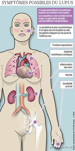 Quel test sanguin est effectué pour diagnostiquer le lupus ? Le guide complet pour comprendre les analyses biologiques