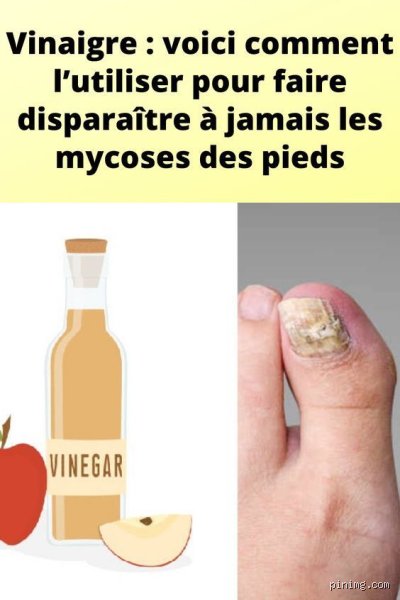 Quel vinaigre pour mycose ?