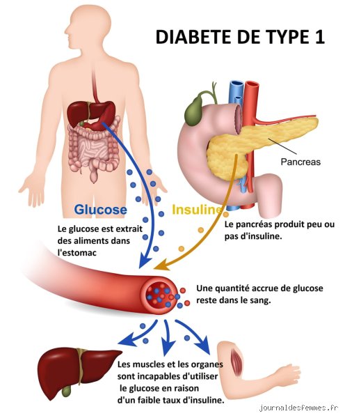 Quelle espérance de vie avec un diabète type 1 ? Ce que les statistiques officielles nous cachent encore