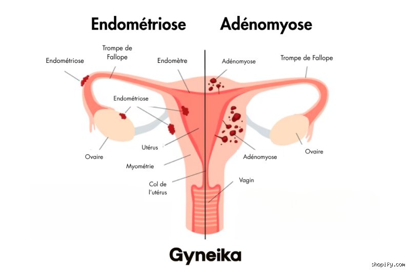 Quelle est l'autre maladie qui ressemble à l'endométriose et pourquoi le diagnostic rate-t-il si souvent sa cible ?