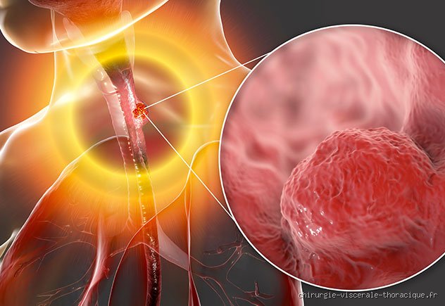 Quelle est l'espérance de vie après un cancer de l'œsophage ? Les chiffres réels et l'impact des nouveaux traitements