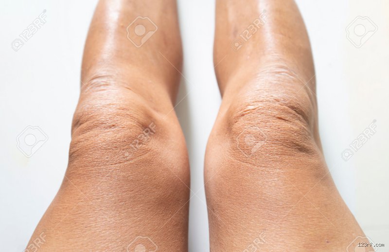 Quelle est la cause de la peau rugueuse sur les genoux ? Comprendre enfin l'origine de cette sécheresse tenace