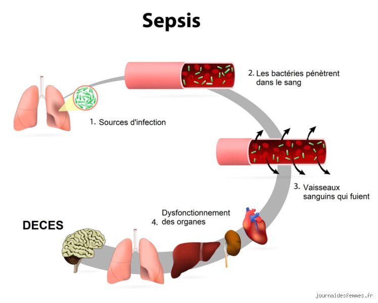 Quelle est la forme la plus grave de septicémie ? Comprendre l'abîme du choc septique et ses mécanismes foudroyants