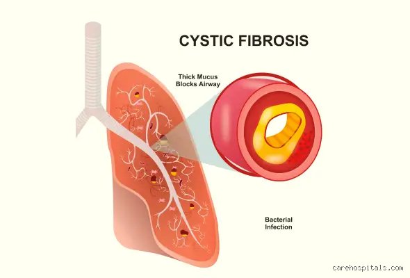 Quelle est la maladie du mucus épais : tout comprendre sur la mucoviscidose, cette pathologie génétique qui asphyxie les organes