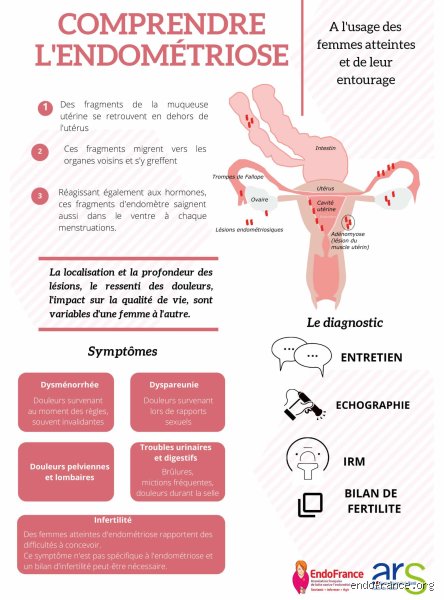 Quelle est la maladie moins grave que l'endométriose ? Diagnostic, nuances cliniques et réalités des douleurs pelviennes