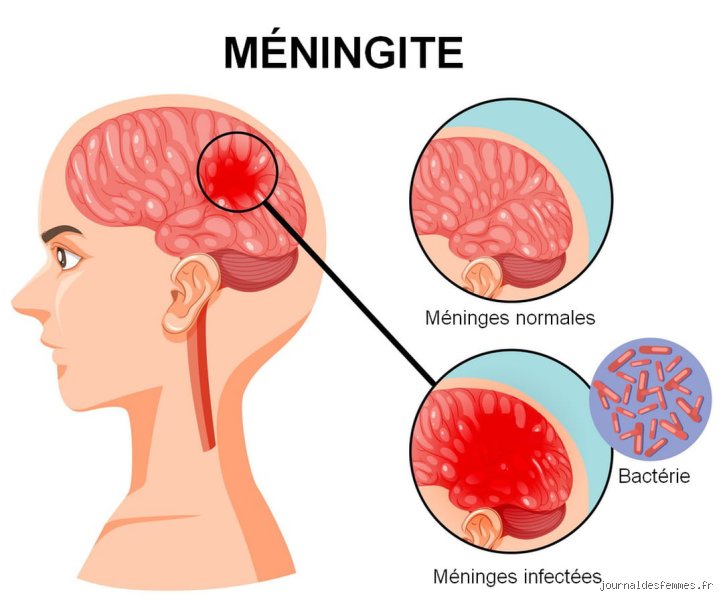 Quelle est la maladie neurologique foudroyante la plus fréquente ? Le diagnostic sans détour d'une urgence vitale absolue