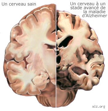 Quelle est la maladie qui détruit le cerveau ? Voyage au cœur de la neurodégénérescence et des mécanismes du déclin cognitif
