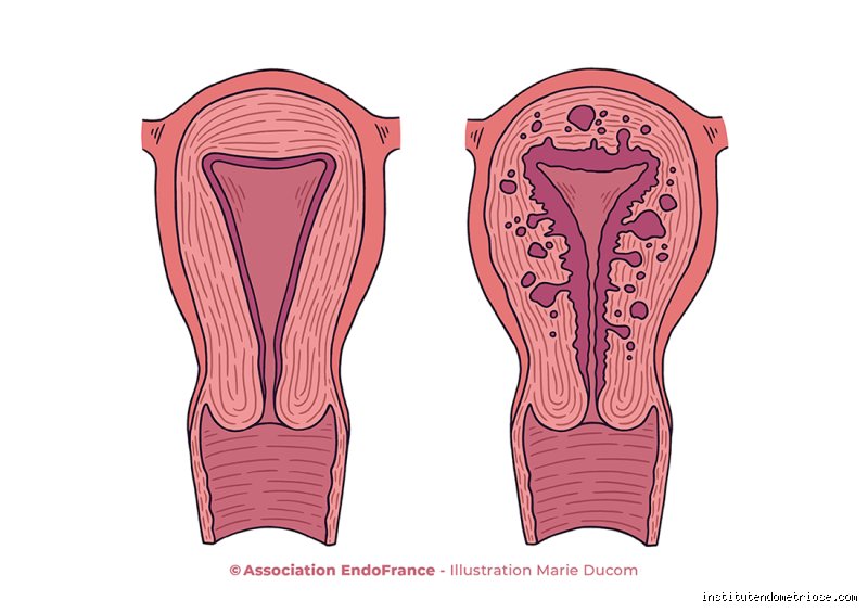 Quelle est la maladie qui ressemble à l'endométriose ? Le guide complet pour enfin comprendre l'adénomyose et les diagnostics différentiels