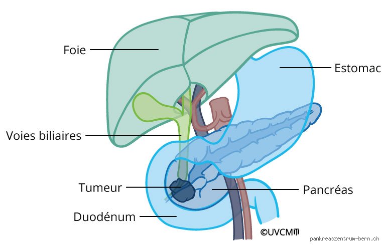 Quelle est la masse non cancéreuse la plus fréquente du pancréas ? Diagnostic, confusion et réalité clinique du cystadénome séreux