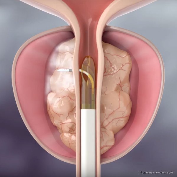 Quelle est la nouvelle technique pour réduire la prostate sans passer par la chirurgie lourde et ses effets secondaires redoutés ?