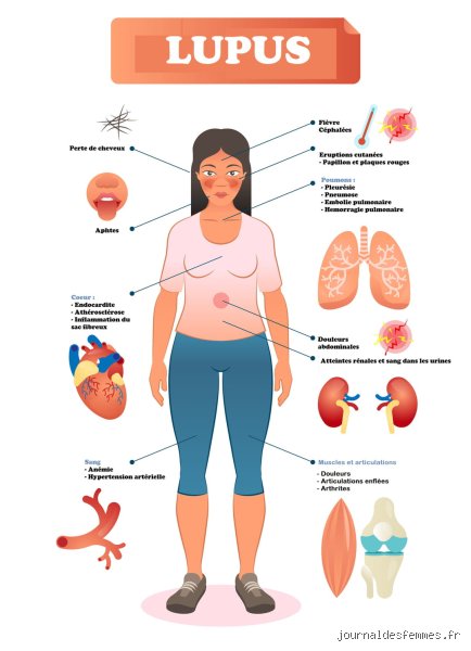 Quelle est la principale cause de décès chez les personnes atteintes de lupus ? Vérités cliniques et réalités statistiques