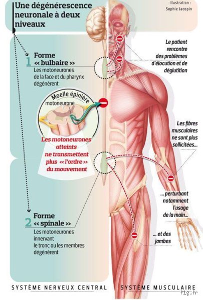 Quelle maladie détruit les muscles ? Le point complet sur les myopathies et la fonte musculaire pathologique