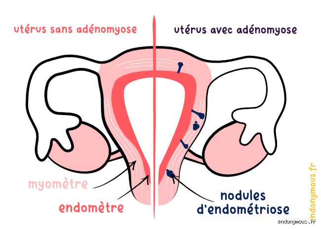 Quelle maladie est similaire à l'endométriose ? Le guide pour ne plus confondre les douleurs pelviennes chroniques