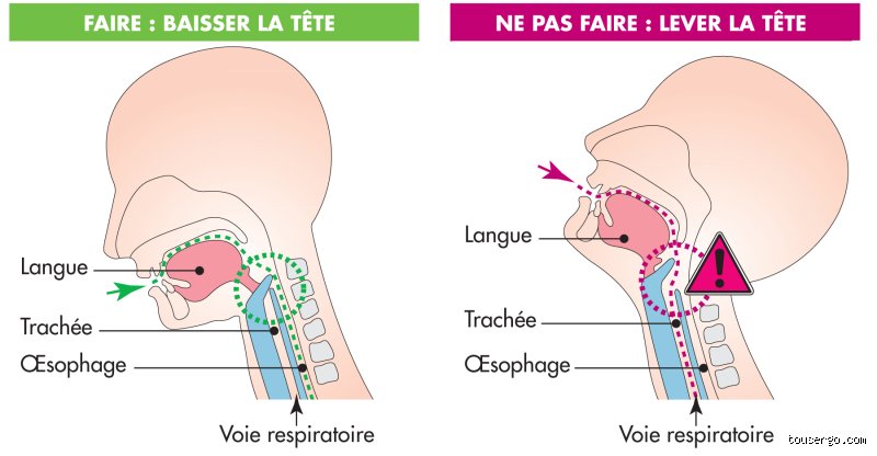 Quelle maladie provoque des fausses routes fréquentes chez l'adulte et comment l'identifier rapidement