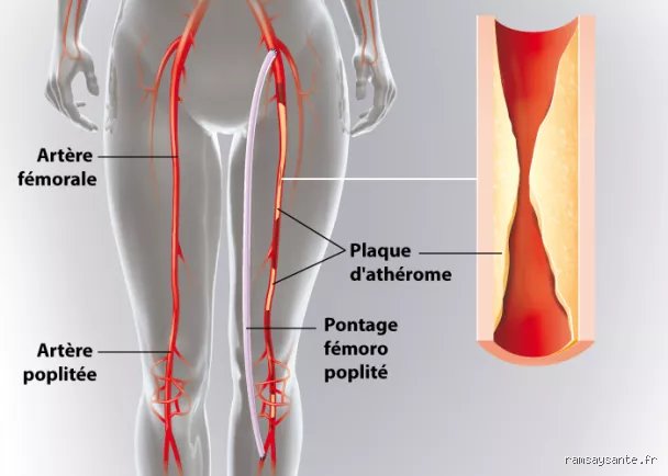 Quelle opération pour déboucher les artères des jambes quand la maladie artérielle périphérique s'installe durablement