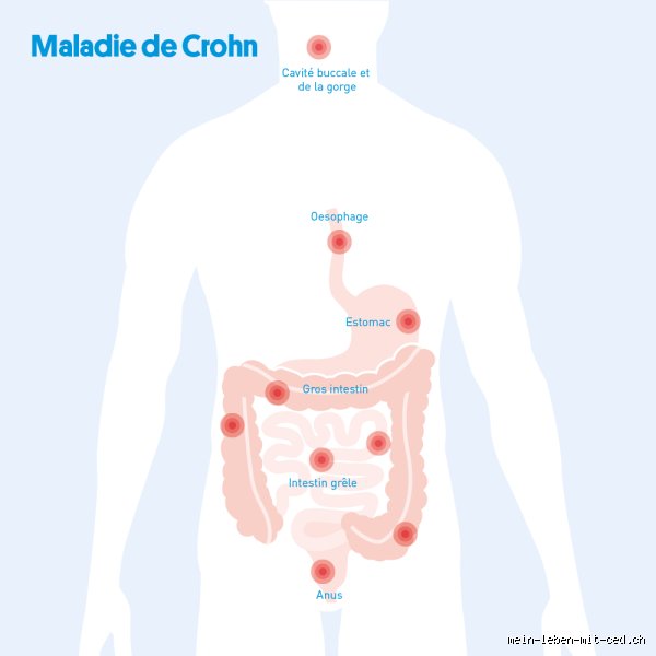 Quelle partie du corps est affectée par la maladie de Crohn ? Tout ce qu'il faut savoir sur l'impact digestif et systémique