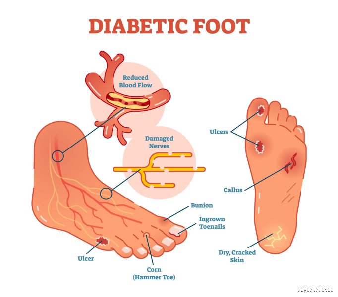 Quelle partie du pied fait mal en cas de diabète ? Comprendre les zones à risque pour éviter l'irréparable