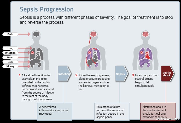 Quelles sont les étapes de la septicémie, dans l'ordre ? Comprendre le basculement d'une infection banale vers l'urgence vitale absolue