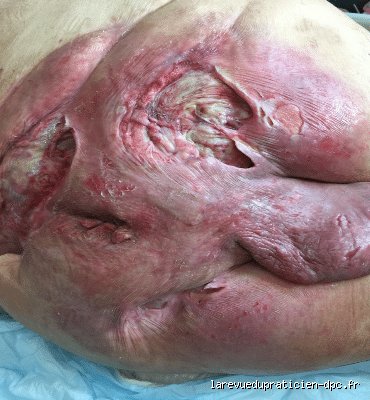 Quelles sont les infections bactériennes graves : le guide complet pour comprendre les menaces invisibles qui s'attaquent à notre organisme