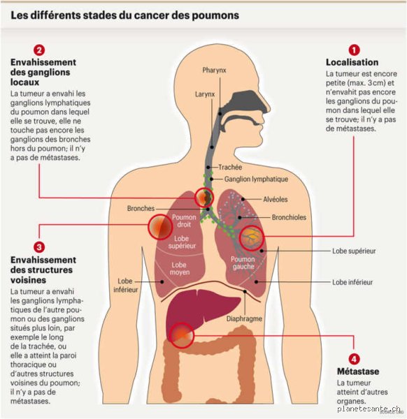 Quelqu'un a-t-il déjà survécu à un cancer du poumon de stade 4 ? Réalités, chiffres et espoirs réels en 2026