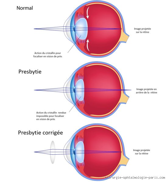 Quels sont les défauts de la vision ? Comprendre enfin pourquoi votre vue déraille et comment l'œil humain perd pied
