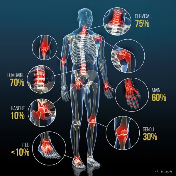 Quels sont les effets à long terme de l'arthrose : comprendre l'érosion silencieuse et les répercussions systémiques sur votre vie quotidienne