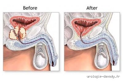 Quels sont les inconvénients d'une opération de la prostate ? Le guide sans tabou sur les séquelles et les réalités chirurgicales