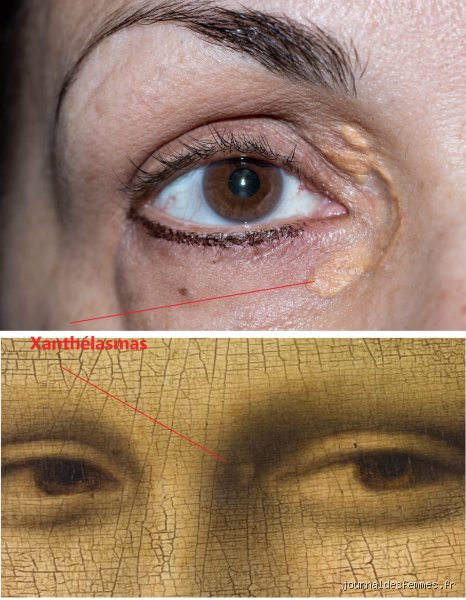 Quels sont les premiers signes d’alerte du cholestérol qui se cachent à la vue de tous ?