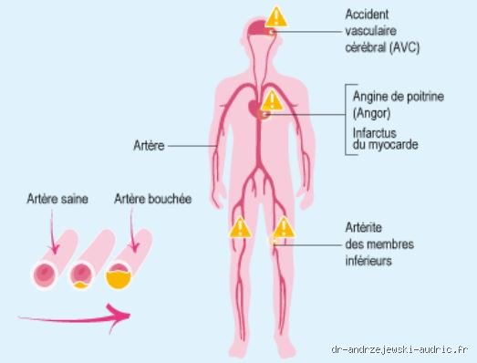 Quels sont les premiers signes d’artères obstruées : le guide complet pour identifier les alertes silencieuses avant l'accident