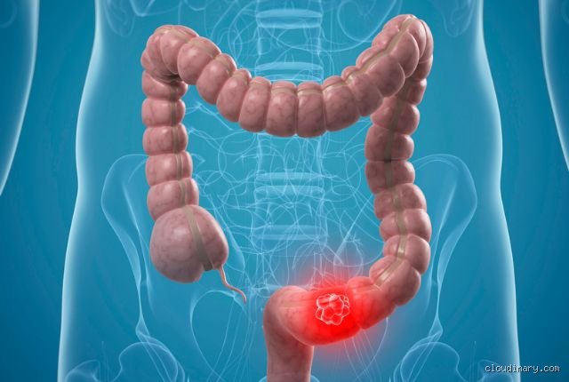 Quels sont les premiers signes d’une inflammation du côlon et comment les identifier avant qu’ils ne gâchent votre quotidien ?