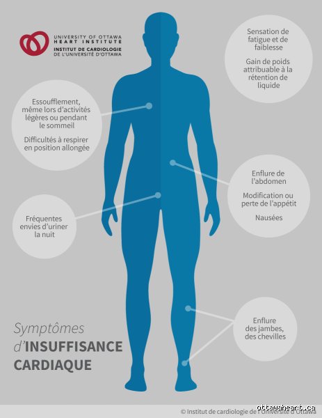 Quels sont les quatre signes d'une défaillance cardiaque silencieuse à ne surtout pas ignorer pour protéger sa vie