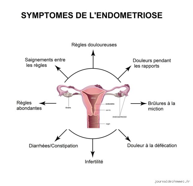 Quels sont les signes d'alerte de l'endométriose : comment identifier les symptômes d'une maladie qui s'ignore encore trop souvent ?