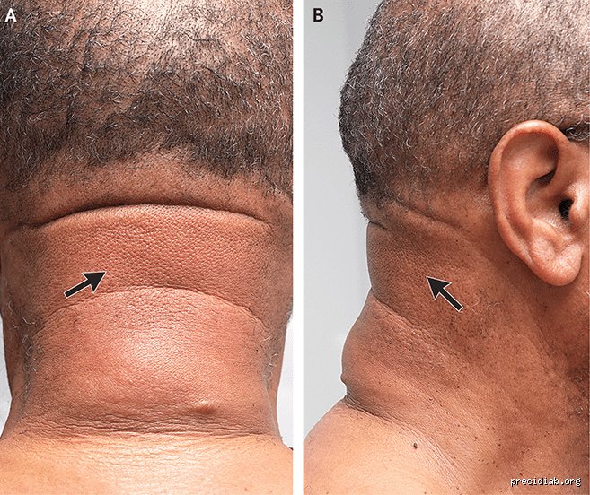 Quels sont les signes de diabète sur la peau : le guide complet pour identifier les alertes cutanées précoces