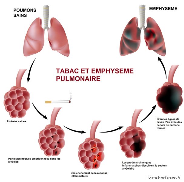 Quels sont les signes de l'emphysème pulmonaire ? Détecter à temps cette dégradation irréversible des poumons