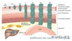Comprendre quels sont les stades du cancer de l'œsophage pour mieux appréhender le diagnostic médical