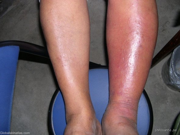 Quels sont les symptômes d'une infection grave : les signaux d'alarme que votre corps hurle avant le point de non-retour