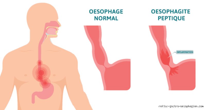 Quels sont les symptômes d'une inflammation grave de l'œsophage : quand l'œsophagite devient-elle une urgence vitale ?