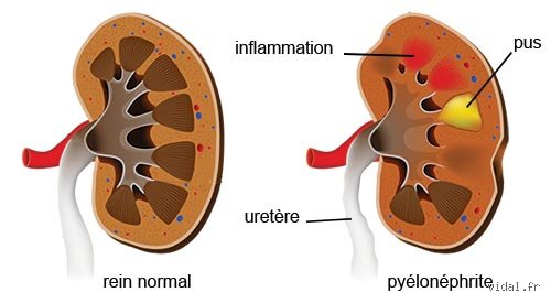 Quels sont les symptômes de la pyélonéphrite ? Reconnaître l'urgence d'une infection rénale qui ne dit pas toujours son nom