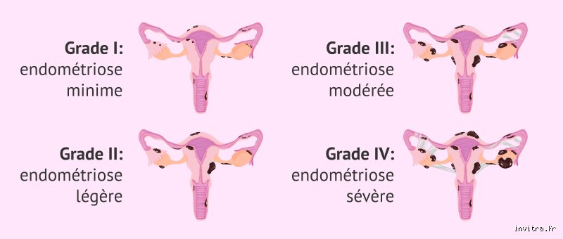 Quels sont les trois D de l'endométriose : comprendre cette triade de symptômes qui bouleverse le diagnostic médical