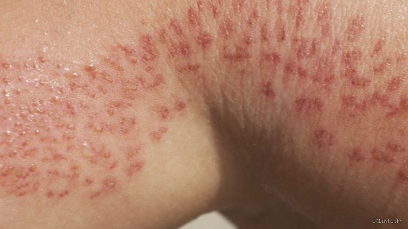 Un bain de bicarbonate de soude soulage-t-il les démangeaisons ? Ce que la science et les dermatos disent vraiment du remède de grand-mère