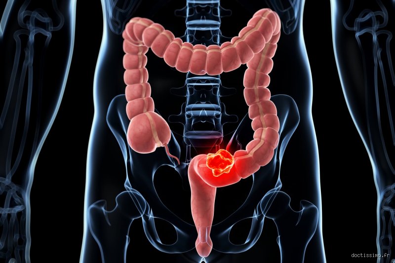 Un côlon enflammé peut-il être cancéreux ? Comprendre la frontière poreuse entre inflammation intestinale et risques de tumeurs